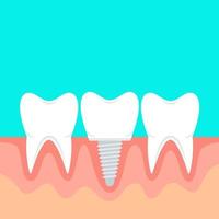 Human teeth and dental implant. Vector stock illustration in flat style with copy space.