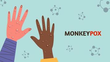 Monkeypox virus. Human hands with papules. Vector stock illustration.