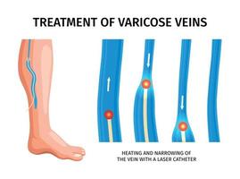 ilustración del tratamiento de las venas varicosas vector