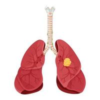 Diagram lung cancer disease. Concept disease human internal organs. Vector illustration, cartoon style.