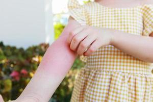 Little girl has skin rash allergy and itchy on her arm photo