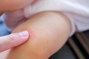 mother apply antiallergic cream at baby knee with skin rash and allergy with red spot cause by mosquito bite photo