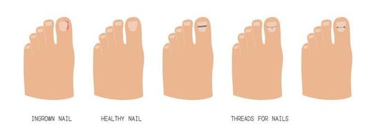 Treatment of ingrown toenail with titanium brackets different types. Hand drawn vector illustration