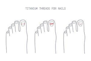 Treatment of ingrown toenail with titanium brackets different types. Hand drawn vector illustration