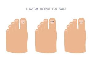 Tratamiento de uñas encarnadas con brackets de titanio de diferentes tipos. ilustración vectorial dibujada a mano vector