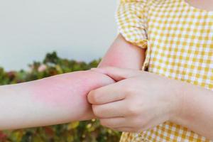 Little girl has skin rash allergy and itchy on her arm photo