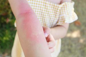 Little girl has skin rash allergy and itchy on her arm photo