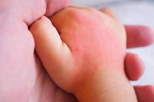 mano de bebé con erupción cutánea y alergia con mancha roja causada por picadura de mosquito foto