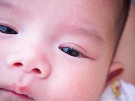 newborn baby with allergy on face photo