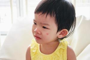 Cute little asian girl with allergy red spot on face cause by insect bite photo