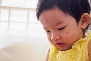 Cute little asian girl with allergy red spot face cause by insect bite photo