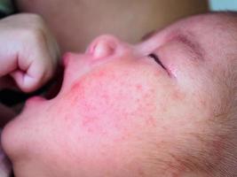 newborn baby with allergy on face photo