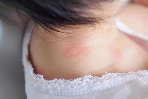 erupción cutánea del bebé y alergia con mancha roja causada por la picadura de mosquito en el cuello foto