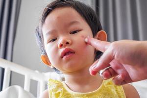 mother applying antiallergic medicine cream at cute asian girl face with skin rash and allergy with red spot cause by mosquito bite photo