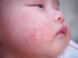 newborn baby with allergy on face photo