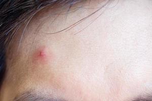 Inflammatory acne with red spot on face closeup photo