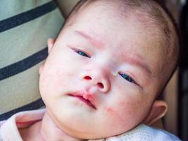 newborn baby with allergy on face photo