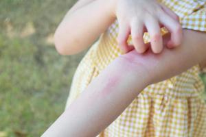 Little girl has skin rash allergy and itchy on her arm photo