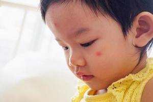 linda niña asiática con alergia en la cara de la mancha roja causada por la picadura de un insecto foto