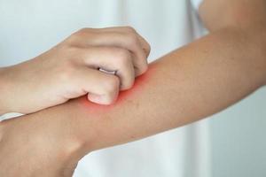 hombre picazón y rascado en el brazo por picazón en la piel seca eczema dermatitis foto