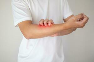 hombre picazón y rascado en el brazo por picazón en la piel seca eczema dermatitis foto
