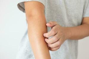 Young asian man itching and scratching on arm from itchy dry skin eczema dermatitis photo