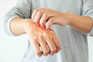 Young asian man itching and scratching on hand from itchy dry skin eczema dermatitis photo