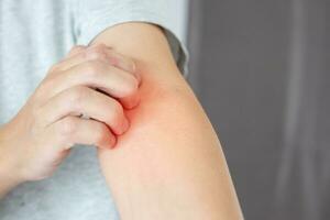 joven asiático picazón y rascado en el brazo por dermatitis eczema de piel seca con picazón foto