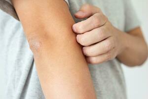 Young asian man itching and scratching on arm from itchy dry skin eczema dermatitis photo