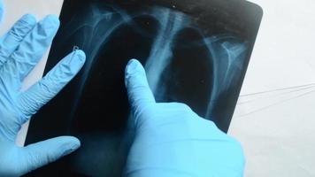 der arzt zeigt in blauen schutzhandschuhen auf die röntgenaufnahme der lunge. nachweistest auf lungenentzündung durch coronavirus, covid-19. Arzt untersucht. video
