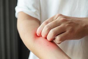 hombre con picazón y rascado en el brazo por picadura de insecto o dermatitis por eczema de piel seca con picazón foto