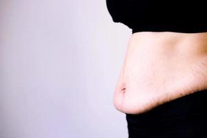 Obese people want to lose weight for good health. photo