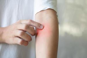 man itching and scratching on arm from insect bite or itchy dry skin eczema dermatitis photo