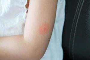 Little girl has skin rash and allergy from mosquito bite photo