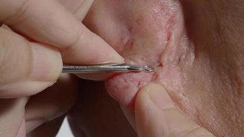 spremitura comedone foruncolo con inossidabile acciaio medico acne rimozione attrezzo. video