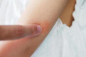 madre aplicando crema antialérgica en el brazo del bebé con erupción cutánea y alergia con mancha roja causada por picadura de mosquito foto