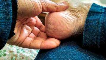 A man shows dry dirty Cracked heels photo