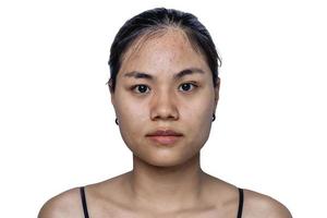 Young Asian woman worry about her face when she has problems with skin on her face in a natural background. Problems with acne and scar on the female skin. Problem skincare and health concept. photo