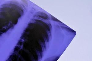 X-Ray film image of human chest for a medical diagnosis on blue hospital table. Flat lay top view photo