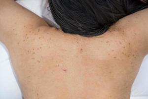 Acne on the back of the skin care woman is caused by bacteria. photo