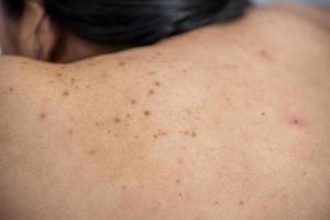 el acné en la parte posterior de la mujer del cuidado de la piel es causado por bacterias. foto