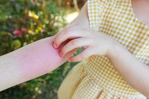 Little girl has skin rash allergy and itchy on her arm photo