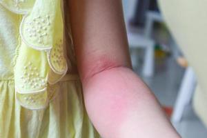 Little girl has skin rash allergy and itchy on her arm photo