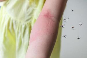 Little girl has skin rash allergy and itchy on her arm from mosquito bite photo