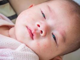 newborn baby with allergy on face photo