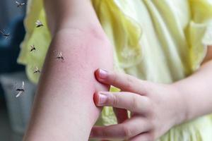 Little girl has skin rash allergy and itchy on her arm from mosquito bite photo