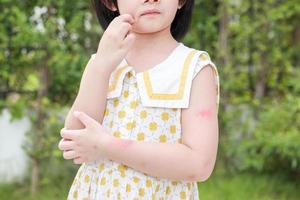 Little girl has skin rash allergy itching and scratching on her arm photo