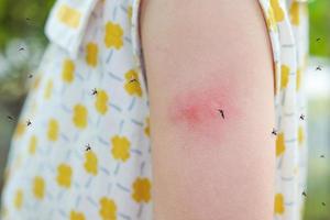 Little girl has skin rash allergy itching and scratching on her arm with mosquitoes bite photo