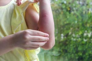 Little girl has skin rash allergy and itchy on her arm photo