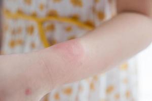 Little girl has skin rash allergy itching and scratching on her arm photo